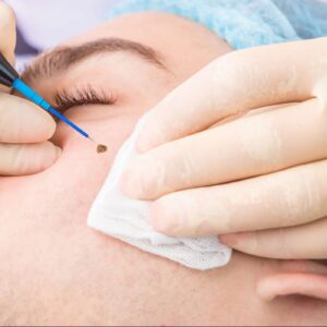 Laser mole removal in Lahore | Rizthetics