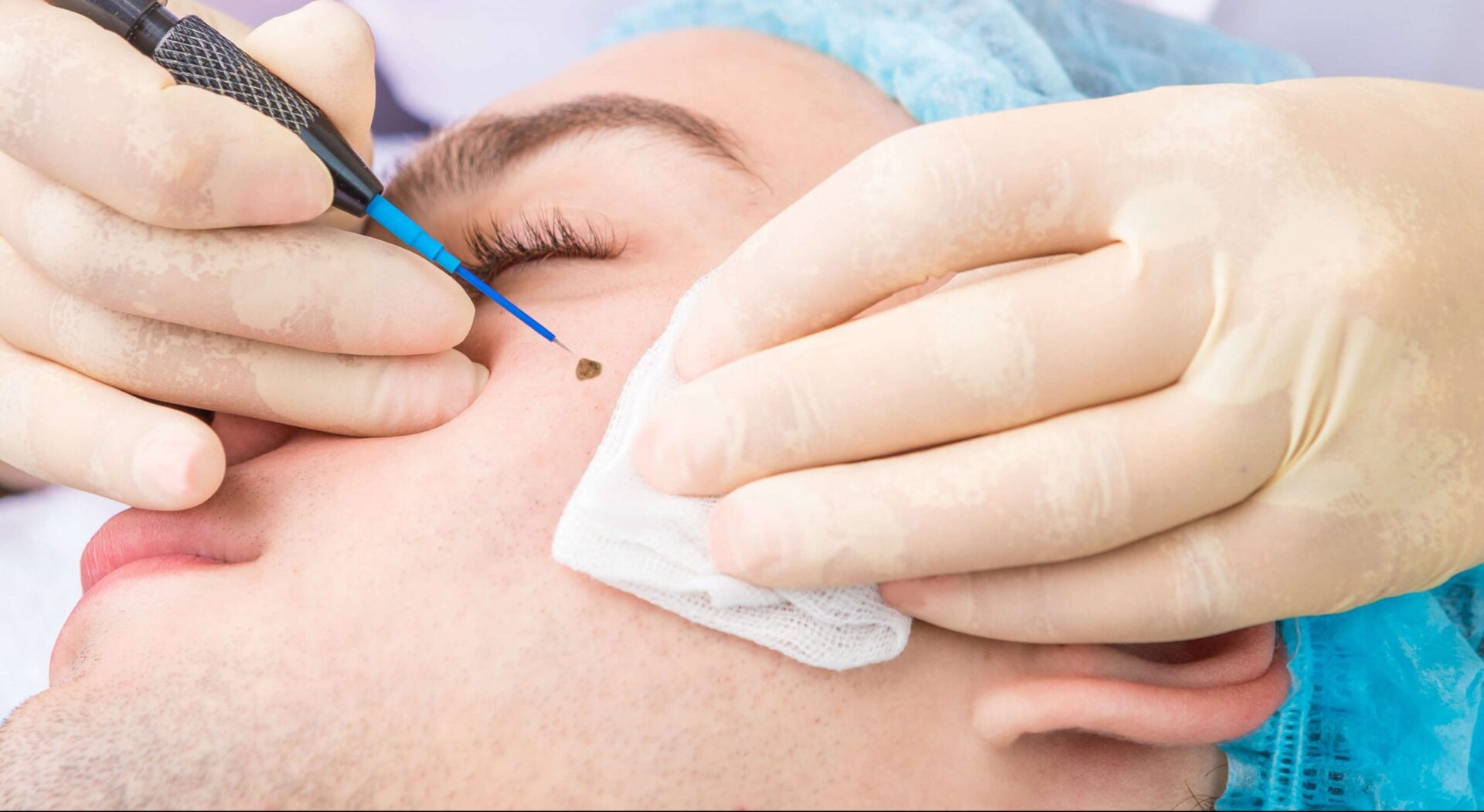 Laser mole removal in Lahore | Rizthetics