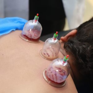 Advance Cupping Workshop in Lahore | Rizthetics