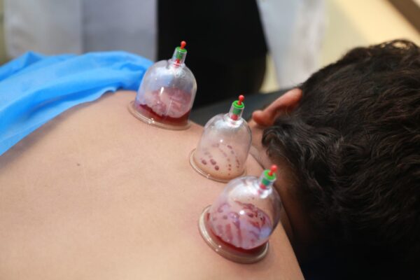 Advance Cupping Workshop in Lahore | Rizthetics